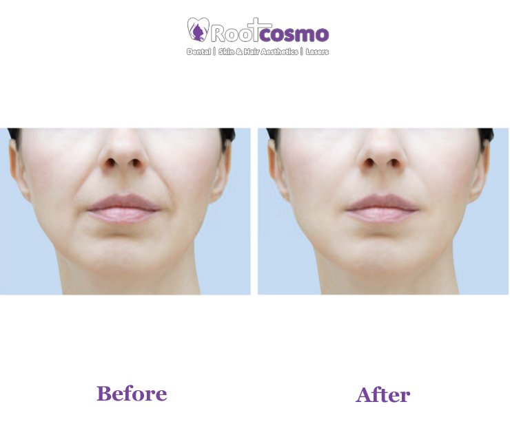 Rediscover Youthful Radiance with Botox (Botulinum Toxin) Injections at ...