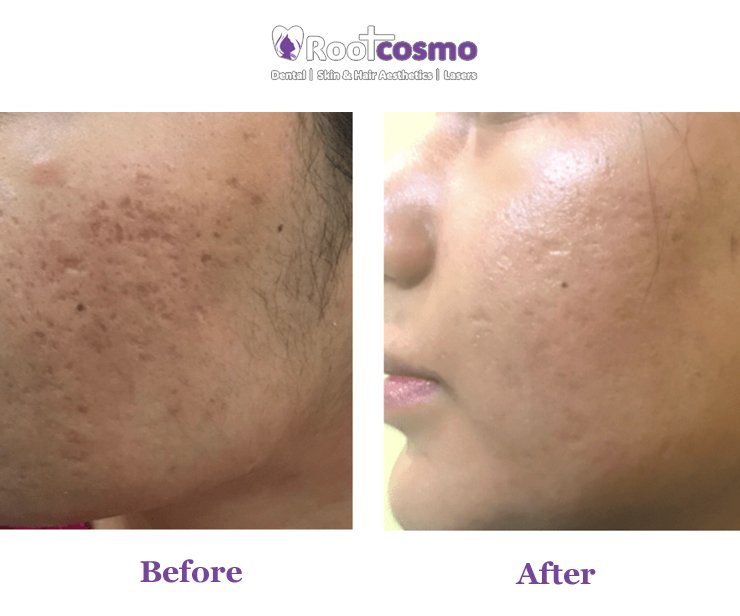 Laser Skin Resurfacing: Unlocking Your Radiant Skin Potential